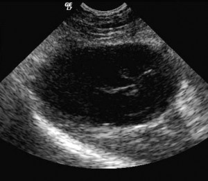 cholecystitis cholecystitis