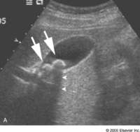 cholelithiasis cholelithiasis