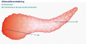 chronische ontsteking van de alvleesklier