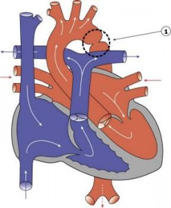 coarctatio aortae coarctatio aortae