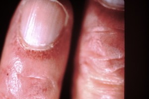 dermatomyositis