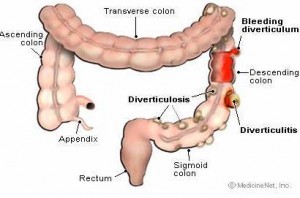 diverticulose