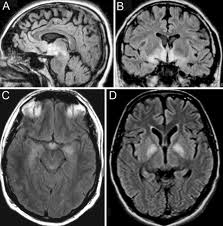 encephalitis