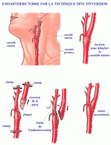 endarteriëctomie