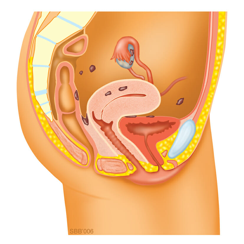 endometriose diarree endometriose diarree
