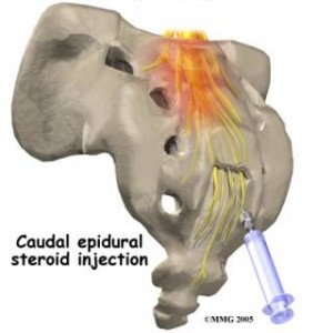 epiduraal abces