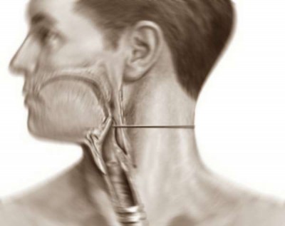 epiglottitis