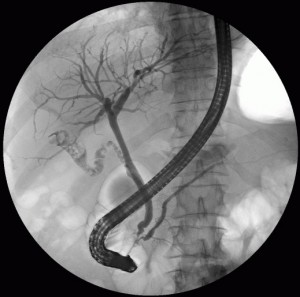 ercp