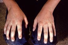 erytheem erytheem
