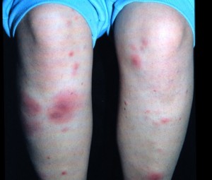 erythema nodosum
