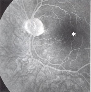 fluorescentie angiografie