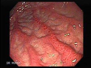 gastritis gastritis