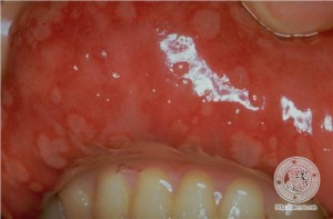 gingivostomatitis