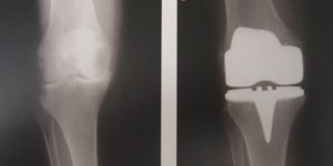 gonarthrosis