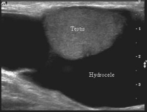 hydrocele