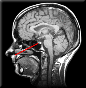 hyperprolactinemie
