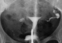 hysterosalpingografie