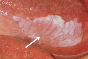 leukoplakie