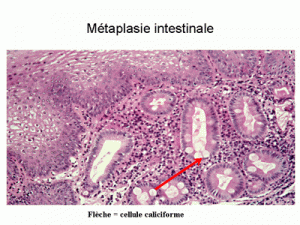 metaplasie