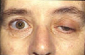 myasthenia gravis
