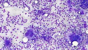 myelofibrose
