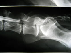 Myelografie Hersenen Menselijk Lichaam Menselijk Lichaam