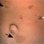 neurofibromatose
