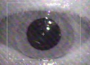 nystagmus