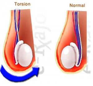orchitis