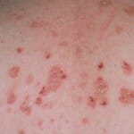 pemphigus