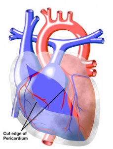 pericarditis pericarditis