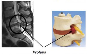 prolaps prolaps
