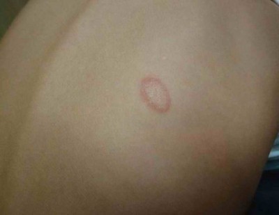 Ronde ringvormige rode plek van ringworm op de huid, met een dikkere rand en een lichter midden