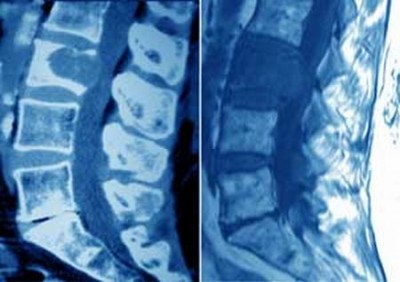 ruggenmergtumor
