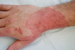 schimmelinfectie