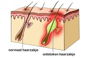 steenpuist