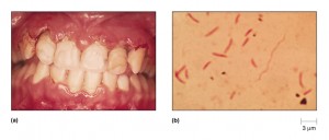 stomatitis van plaut-vincent