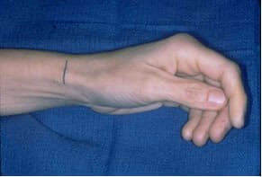 tendinitis2