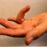tendovaginitis