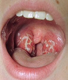 tonsillitis tonsillitis