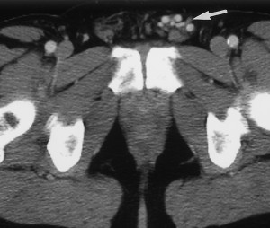 varicocele