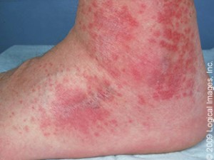 vasculitis