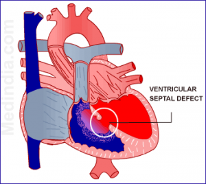ventrikel septum defect ventrikel septum defect
