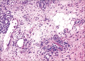 wilms tumor