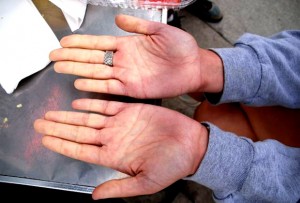 ziekte van raynaud
